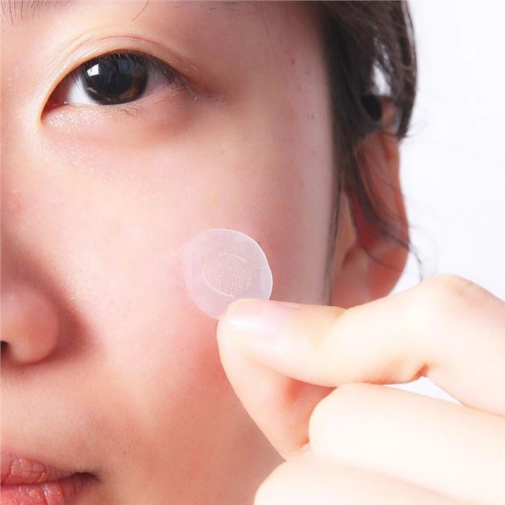 Microneedle patch applied on cheek
